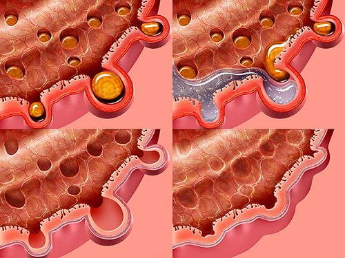 Diverticulitis Treatment