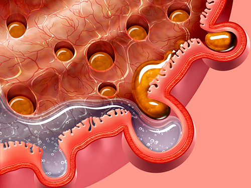 Diverticulitis